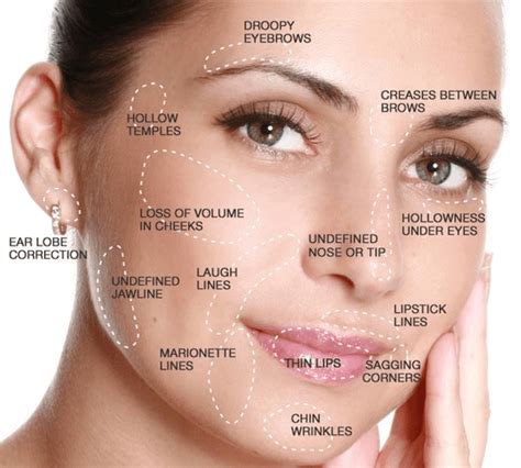 Dermal Fillers In Baltimore Md Collagen Injections Juvederm And Restylane