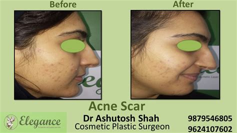 Acne Vulgaris Treatment in Vadodara, Gujarat, India.