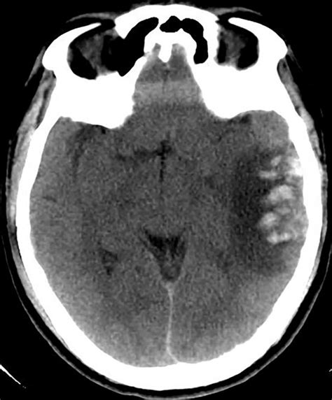 Ct Scan Brain Plain Showing Left Temporal Contusion With Mass Effect Download Scientific