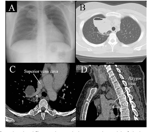 Figure From Congenital Bronchial Atresia With Partial Anomalous