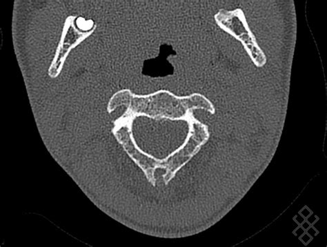 Scanner Du Rachis Cervical D Finition D Roulement Prise De Rdv En