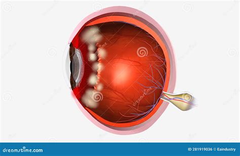 Pars Planitis Is Een Oogziekte Waarbij De Middelste Laag Van Het Oog