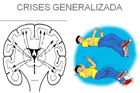 O Que é Epilepsia Tipos Causas Sintomas Remédios Tem Cura