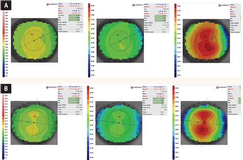 Lesson The Definitive Guide To Corneal Topography