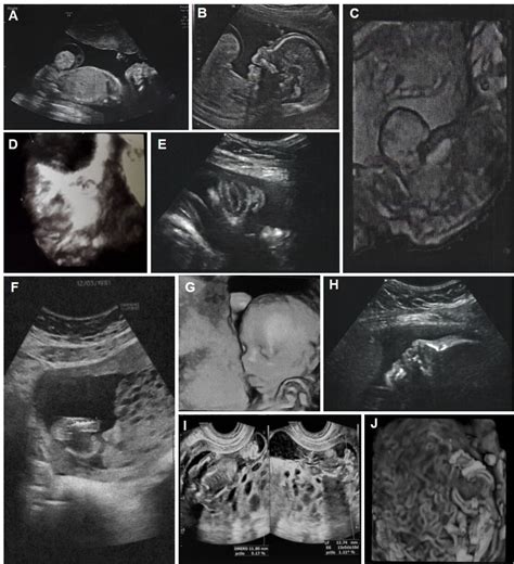 Prenatal Features In Beckwith Wiedemann Syndrome And Indications For