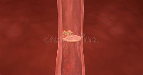 Deep Vein Thrombosis And Pulmonary Embolism Stock Illustration Illustration Of Aorta