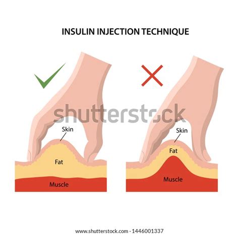 Insulin Injection Technique Over 43 Royalty Free Licensable Stock