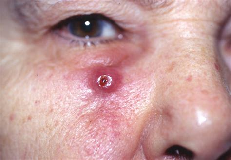 Squamous Cell Carcinoma Scc American Skin Association