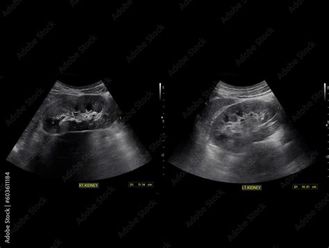 Ultrasound of Kidney or KUB for screening renal stone disease or ...