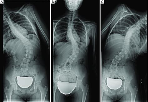 Structural Thoracolumbar Curve No Significant Correction Is Achieved