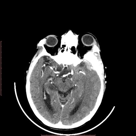 Meningioma Image Radiopaedia Org