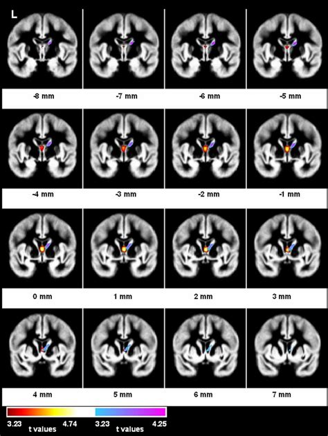 Fig DS1 Whole Brain Grey Matter T Maps Of The Voxel Based Morphometry