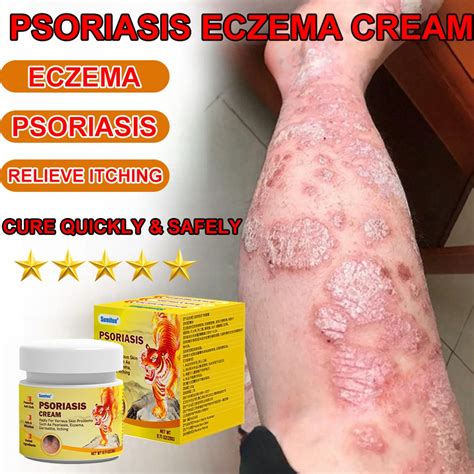 100% Herbal formula Eczema psoriasis cream Antibacterial Itchy Cream ...