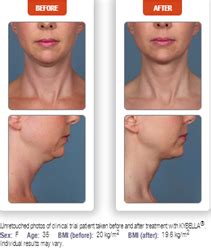 Ethos Spa Skin And Laser Center Announces Availability Of Kybella The