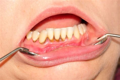 Tartaro sui denti perché si forma come eliminarlo e prevenirlo