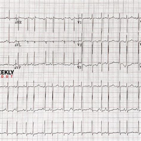 Multifocal atrial tachycardia – ECG Weekly