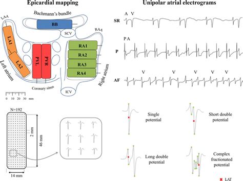 Epicardial Mapping To Retrieve Unipolar Atrial Electrograms With The