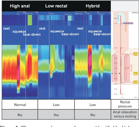 Figure From How To Perform And Interpret A High Resolution Anorectal