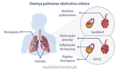 Sintomas De Dpoc