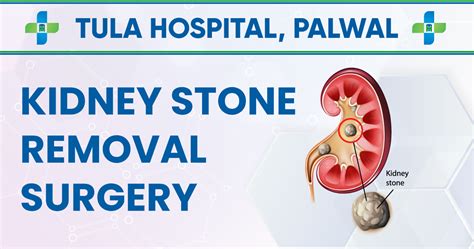 Kidney Stone Removal Surgery - My Blog