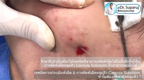 เทคนิคการประเมินพังผืด และการตัดพังผืดหลุมสิว Cannula Subcision ทำไม