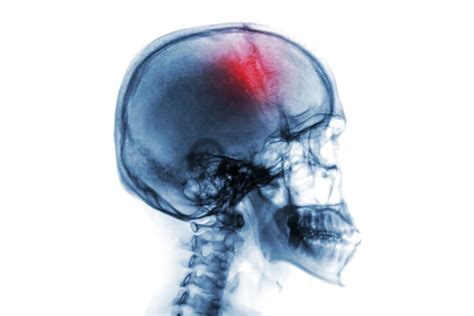 Infarto cerebral: causas y tratamiento - Mejor con Salud