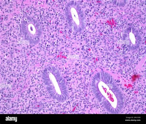 chronic endometritis light micrograph stock photo alamy