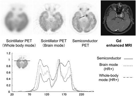 A New Pet Scanner With Semiconductor Detectors Enables Better