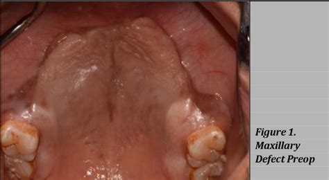 Figure From Prosthodontic Rehabilitation Of Maxillary Defect In A