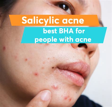 What does salicylic acid do for acne? | MDacne