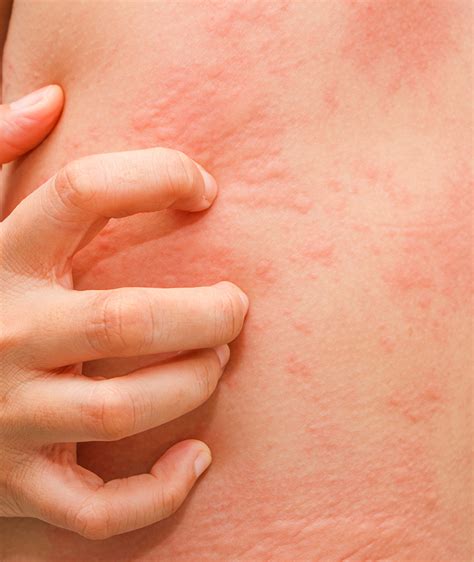 Hives Treatment Mclean Potomac Dermatology