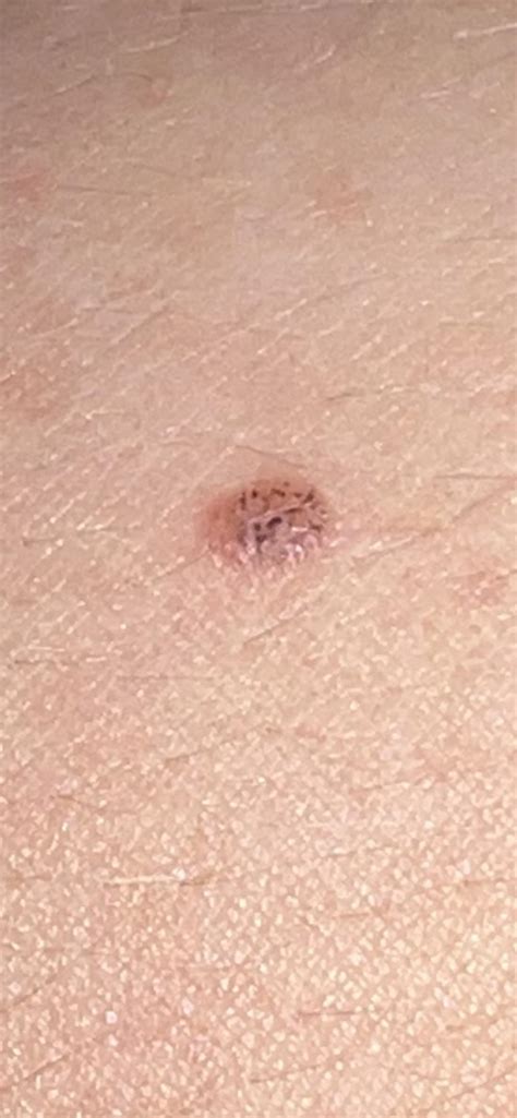 Melanoma : r/Melanoma