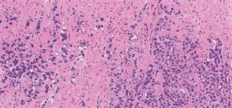 Adenocarcinoma of the prostate gland | Ottawa Atlas of Pathology