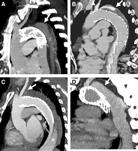 Factors Portending Endoleak Formation After Thoracic Aortic Stent Graft