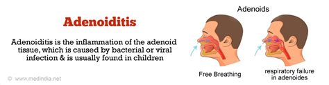 Adenoids | Adenoiditis - Causes, Symptoms, Complications, Diagnosis ...