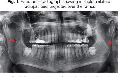 Tonsilloliths Radiograph