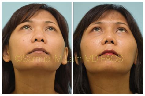 This Asian Patient Is Shown Before And After Augmentation Rhinoplasty