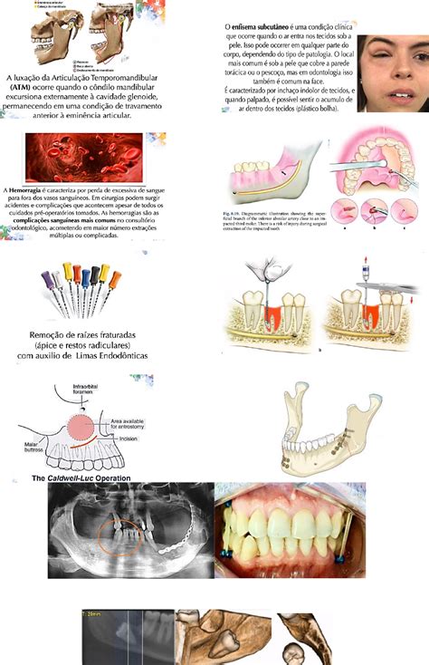 Tópicos Exodontia de dentes complicados planejamento complicações e