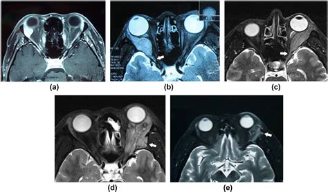 Diagnostic Value Of Dynamic Contrast Enhancement Combined With