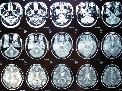 Tumor Cerebral Del Rayo De La Pel Cula X Mi Mather Bangkok Tailandia