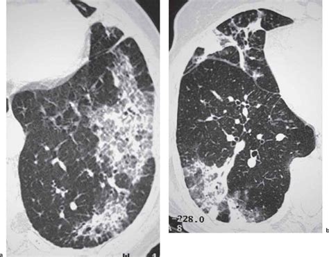 Chronic Obstructive Pulmonary Disease And Diseases Of The Airways