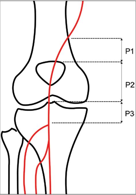 3 Segments Of Popliteal Artery