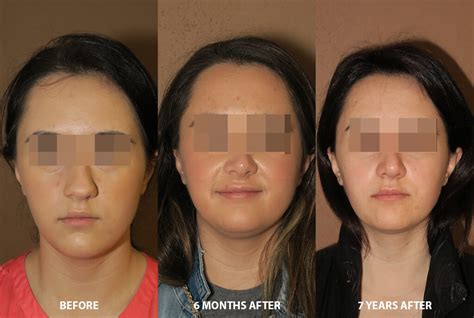 Rhinoplasty – Before and After Pictures * | Dr Turowski - Plastic Surgery Chicago