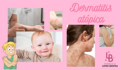 Dermatitis atópica Farmacia López Benítez