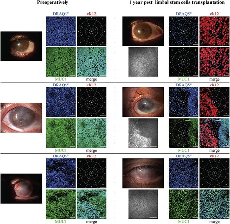 In Vivo Confocal Microscopy Year After Autologous Cultured Limbal