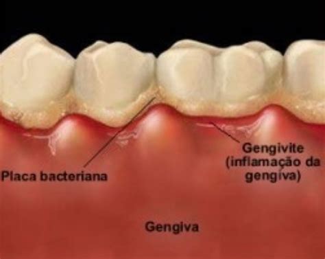 Inter relação da doença periodontal problemas sistêmicos