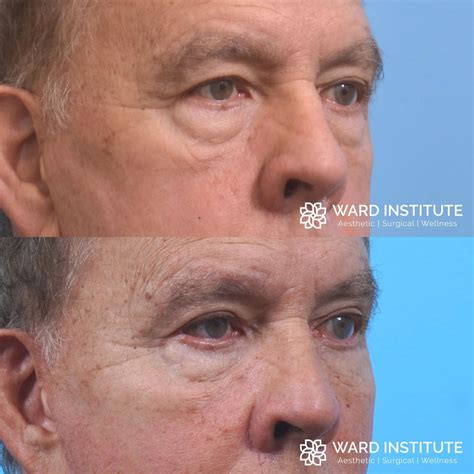 Blepharoplasty Plastic Surgery In Slc Ut Ward Institute