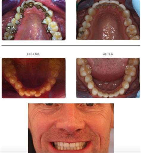 Hidden Lingual Braces: Incognito Treatment Behind Teeth