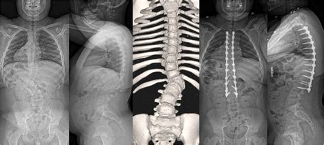 Pre And 2 Year Postoperative Anteroposterior And Lateral Radiographs