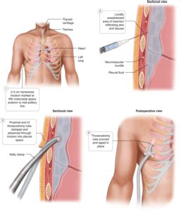 Intercostal Chest Tube Drainage Dr Gopal Chawla